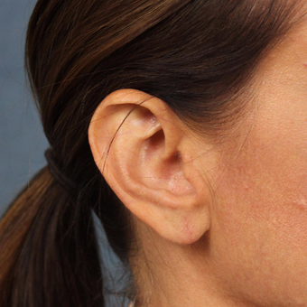 Ear Lobe Lift for recurrent droopiness of earlobes and heavy earrings after 3623421