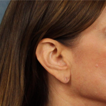 Ear Lobe Lift for recurrent droopiness of earlobes and heavy earrings before 3623421