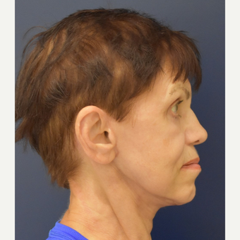65-74 year old woman treated with Facelift after 3448992