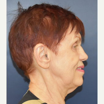 65-74 year old woman treated with Facelift before 3448992