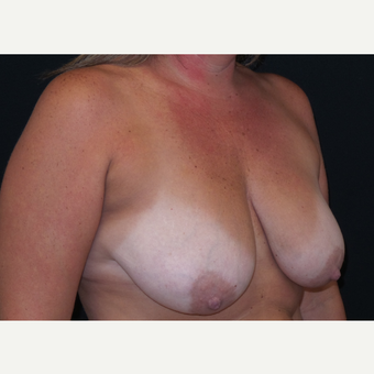 35-44 year old man treated with Breast Lift with Implants before 3305191