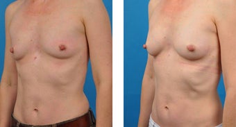 46 Year Old Woman, Fat Transfer to Breasts 1039942