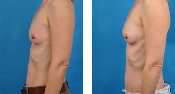 46 Year Old Woman, Fat Transfer to Breasts after 1039942
