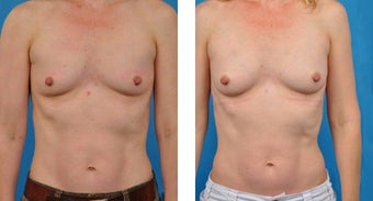 46 Year Old Woman, Fat Transfer to Breasts before 1039942