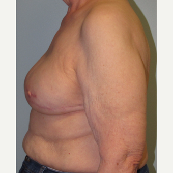 77 year old woman treated with Tissue Expander/Implant Breast Reconstruction + Nipple Reconstruction after 3097680