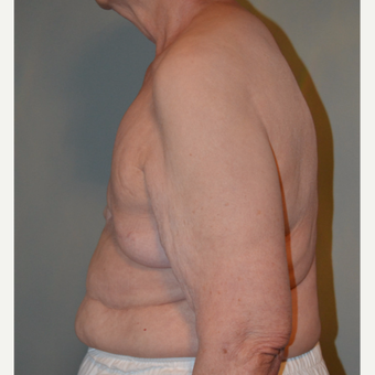 77 year old woman treated with Tissue Expander/Implant Breast Reconstruction + Nipple Reconstruction before 3097680