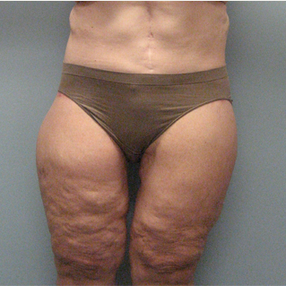 Body Lift after 3680283