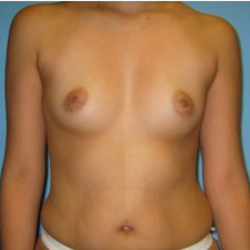 Breast Augmentation before 3665688