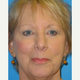 65-74 year old woman treated with Eyelid Surgery after 3570752
