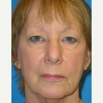 65-74 year old woman treated with Eyelid Surgery before 3570752