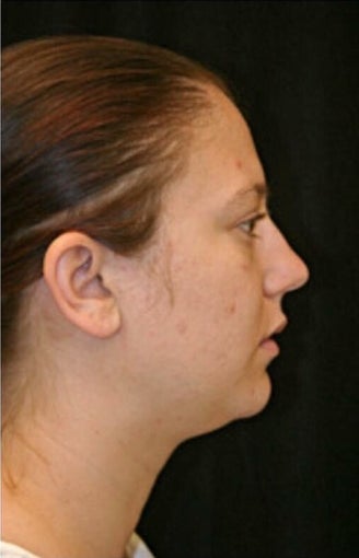 18-24 year old woman treated with Rhinoplasty before 3225733