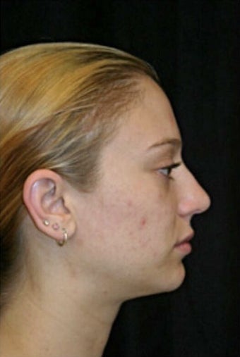 18-24 year old woman treated with Rhinoplasty after 3225733