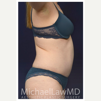 35-44 year old woman treated with Tummy Tuck after 3174275