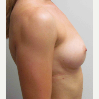 Breast Implants for this 26 Year Old Woman before 3005518