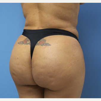 35-44 year old woman treated with Brazilian Butt Lift after 3696124