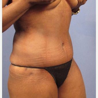 55-64 year old woman treated with Tummy Tuck after 3095827