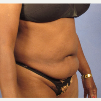 55-64 year old woman treated with Tummy Tuck before 3095827