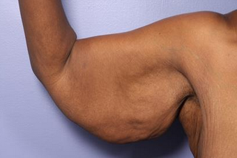 45-54 year old woman treated with Arm Lift before 1679019