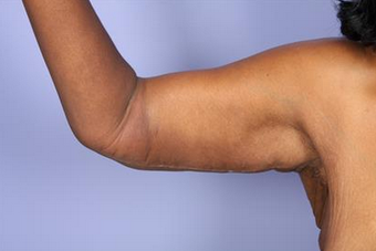 45-54 year old woman treated with Arm Lift after 1679019