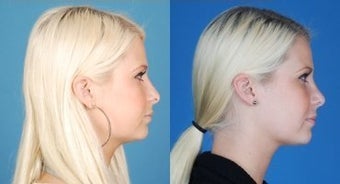 Revision Rhinoplasty - Correction of Alar Malposition, Internal Valve Collapse, Tipplasty after 677065