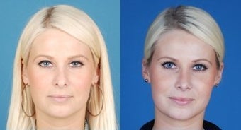 Revision Rhinoplasty - Correction of Alar Malposition, Internal Valve Collapse, Tipplasty before 677065