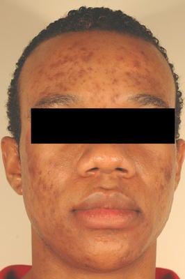 Laser Acne Scar Removal before 82959