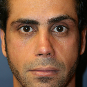 35-44 year old man treated with Revision Rhinoplasty after 3559735