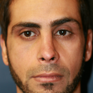 35-44 year old man treated with Revision Rhinoplasty before 3559735