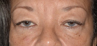 Female Eyelid Surgery before 1034512