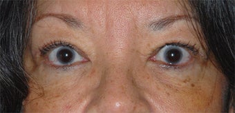 Female Eyelid Surgery after 1034512
