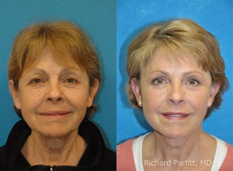 Blepharoplasty and Facelift before 1457339
