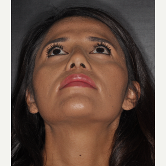 25-34 year old woman treated with Septoplasty 10 days post-op after 3452284