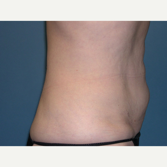 CoolSculpting after 2898903