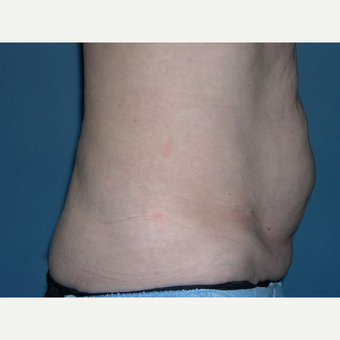 CoolSculpting before 2898903