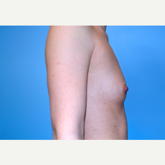 18-24 year old woman treated with Breast Implants before 3439920