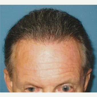 55-64 year old man treated with Hair Transplant after 3494854