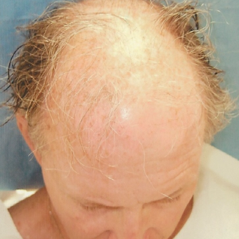55-64 year old man treated with Hair Transplant before 3494854