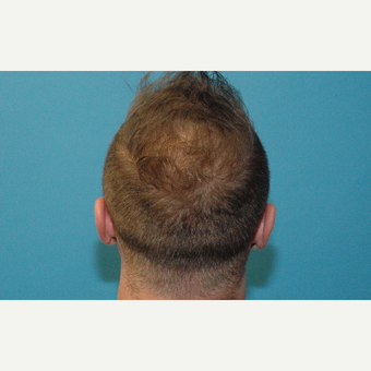 37 year old man treated with NeoGraft hair transplantation after 3241799