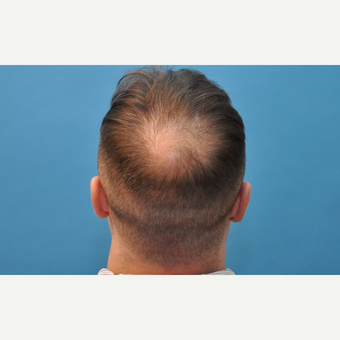 37 year old man treated with NeoGraft hair transplantation before 3241799