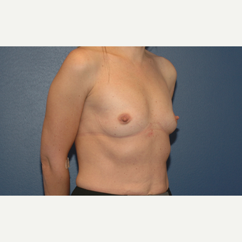 22 year old woman treated with Breast Augmentation before 3200929
