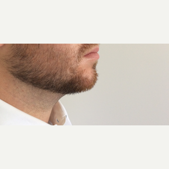 Radiesse Chin Enhancement after 3042511