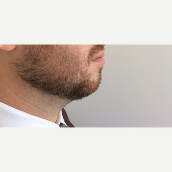 Radiesse Chin Enhancement before 3042511