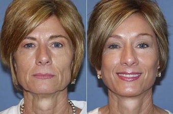 53yo Dr Mark Prysi performed Endoscopic Browlift, Endoscopic Composite Faclift and Laser Resurfacing before 1245712
