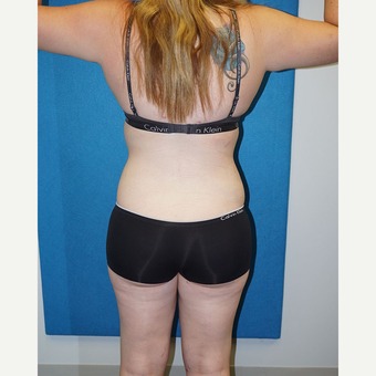 17 year old woman treated with Liposuction after 3576687