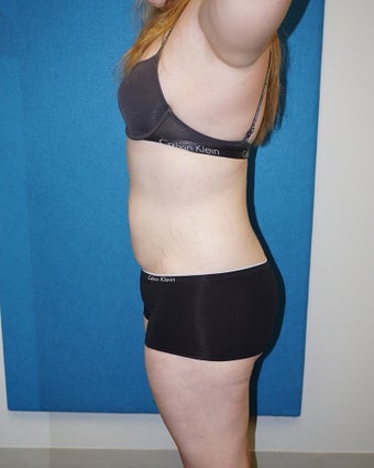 17 year old woman treated with Liposuction 3576687