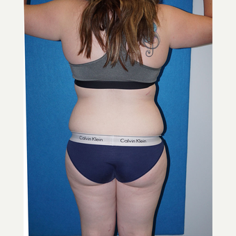 17 year old woman treated with Liposuction before 3576687