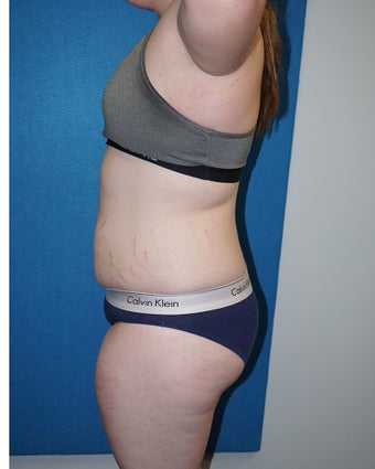 17 year old woman treated with Liposuction 3576687