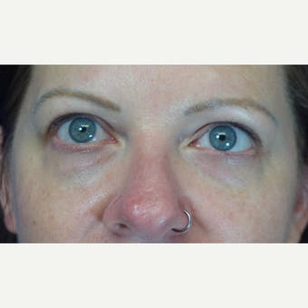 35-44 year old woman treated with Eyelid Surgery before 3376051
