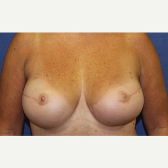 50 year old woman with a bilateral breast reconstruction using a tram flap after 3589112