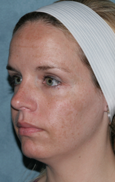 Fraxel Dual Laser Treatment before 1064719